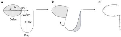 Application of vertical transposition flap in closure for large facial soft tissue defects in children